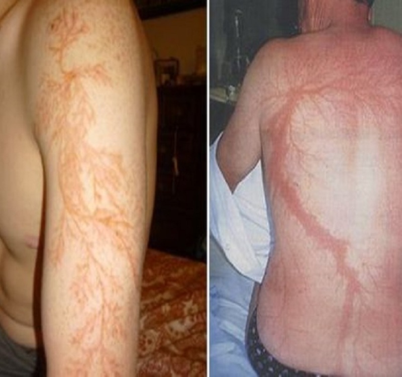 هل تعلم ماذا يحدث عندما يضرب البرق جسم الإنسان؟  صور مذهلة وتفاصيل غير متوقعة